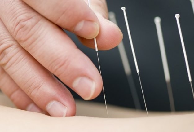 Treatment-Acupuncture-Fasting.jpg